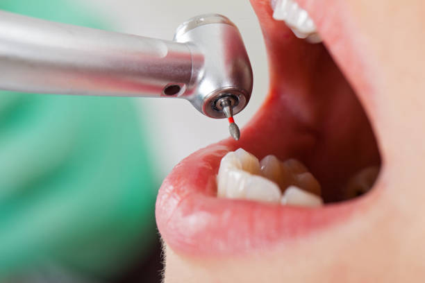 Best Emergency Dental Filling Replacement  in Covington, WA